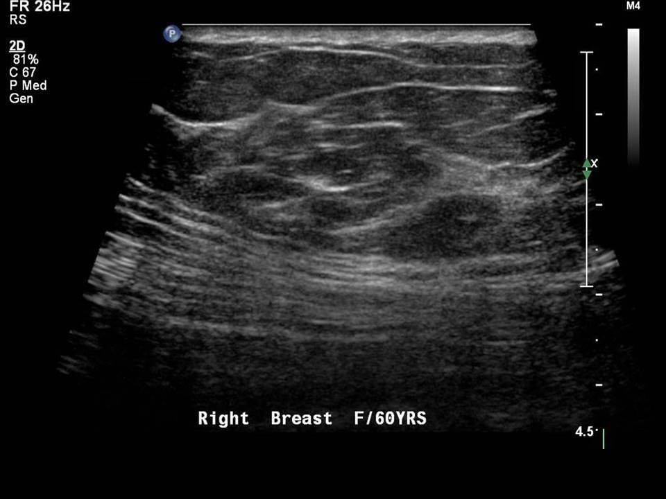 Breast USG